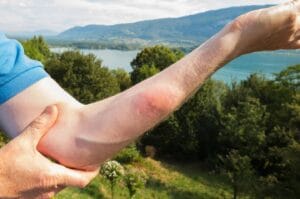 Biografie der parasitären Hautreaktionen